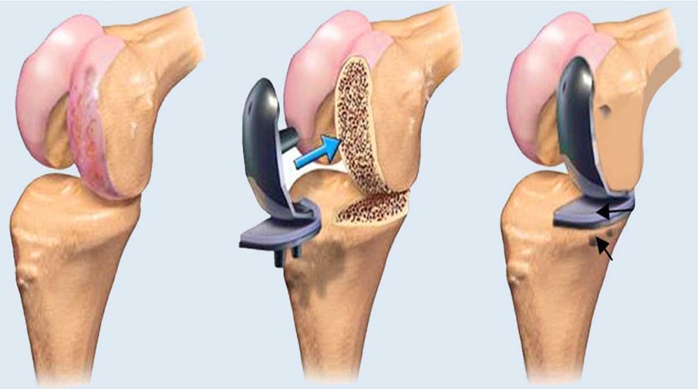 Arthroplasty Surgery